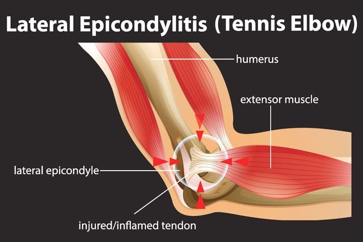 tennis elbow