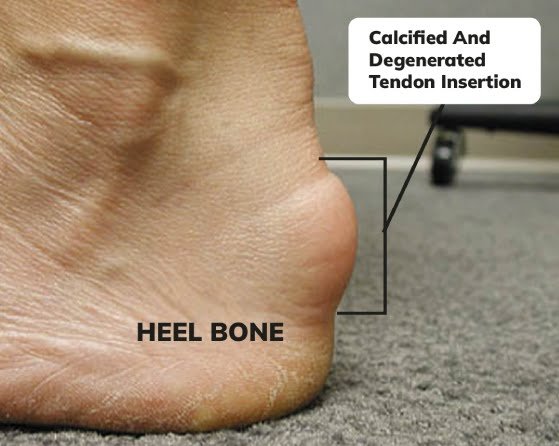 Achilles heal bone