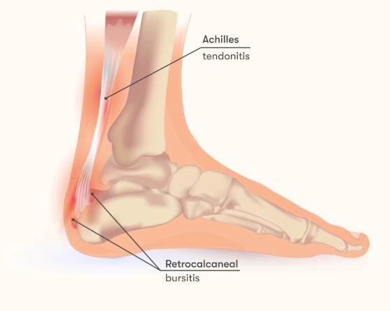 Retrocalcaneal Bursitis