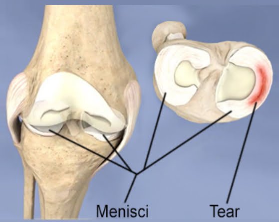 Meniscal Tears blog