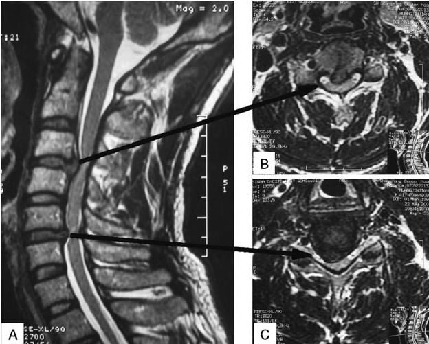 Cervical spondylosis ABC