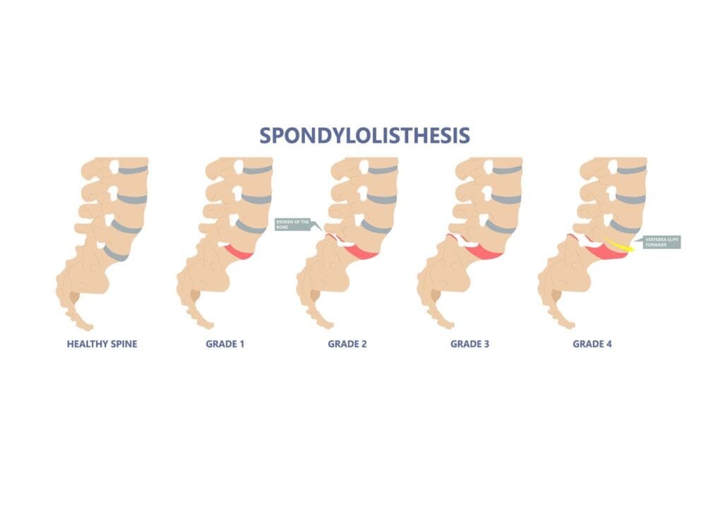 back pain