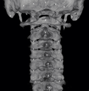 neckpain blog5 img