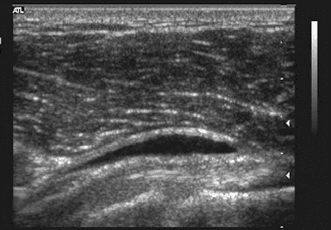 ultra sound