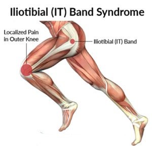 Iliotibial Band Syndrome boulder medical center 300x300