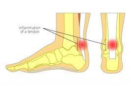 Achilles tendonitis