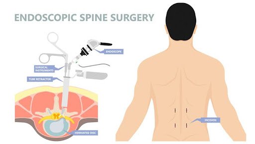 Endoscopic Spine Surgery
