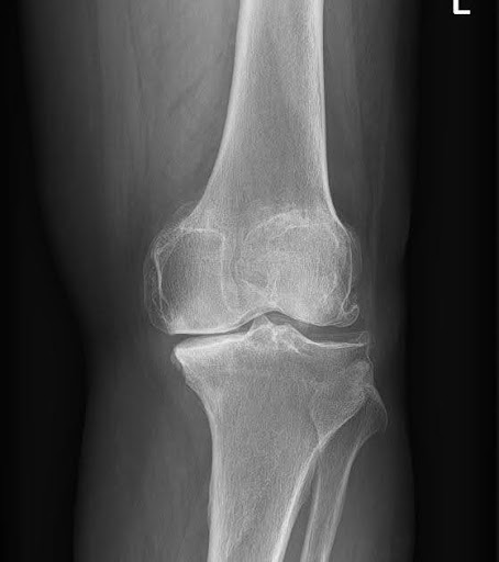 Knee X ray Showing Grade 3 Knee Osteoarthritis