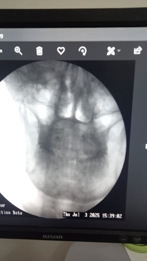 Anterior posterior fluoroscopic X ray image of the cervical spine