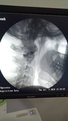 Fluoroscopic X ray showing needle placement in cervical spine during interventional procedure