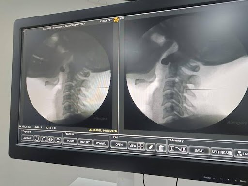 Side by side lateral fluoroscopic X rays of cervical spine used for interventional guidance