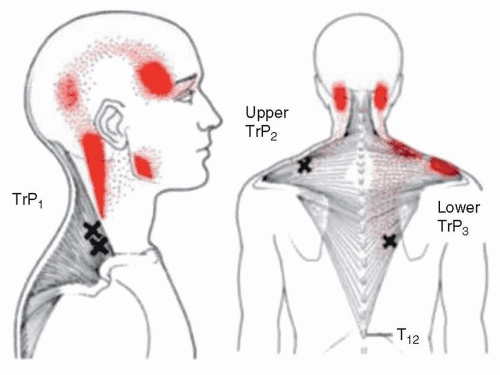 Trigger points and pain referral areas in neck and upper back muscles