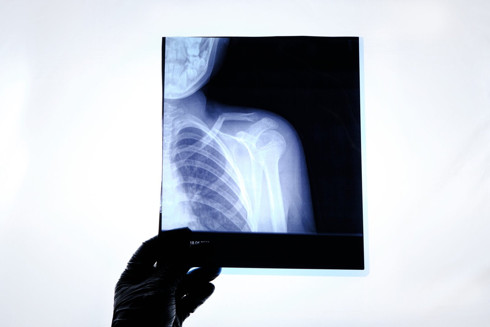 X ray image of a man with a broken collarbone.