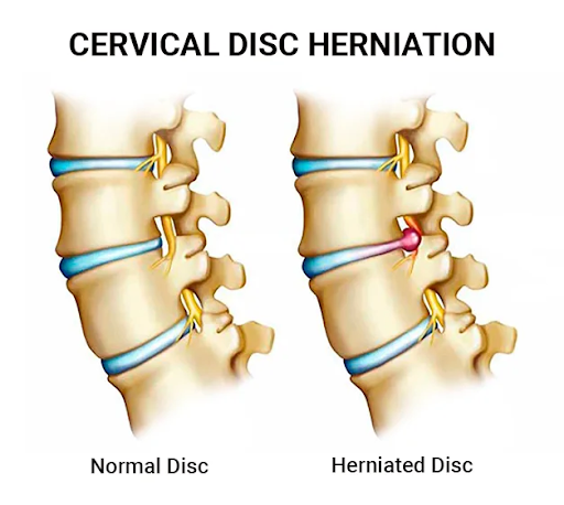 Cervical spine comparison showing normal disc vs herniated disc