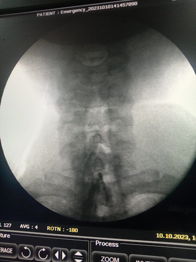 Fluoroscopic X-ray of cervical spine showing vertebral alignment