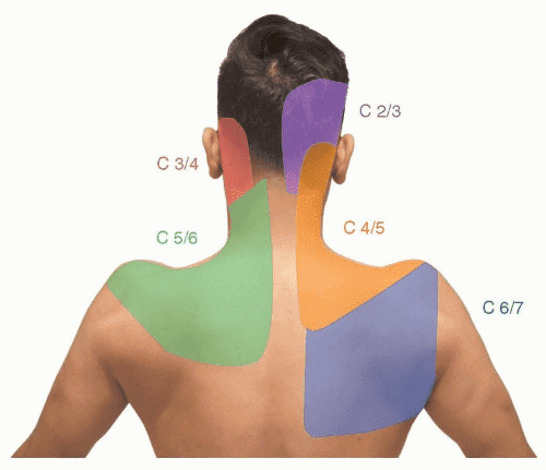 Color map depicting cervical facet joint pain referral patterns across the upper back and neck