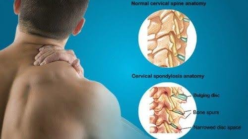 Comparison of normal cervical spine vs. spondylosis with bulging disc, bone spurs, and narrowed disc space