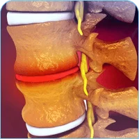 Degenerative Disc Disease
