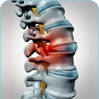 Herniated Discs