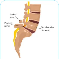 Spondylolisthesis