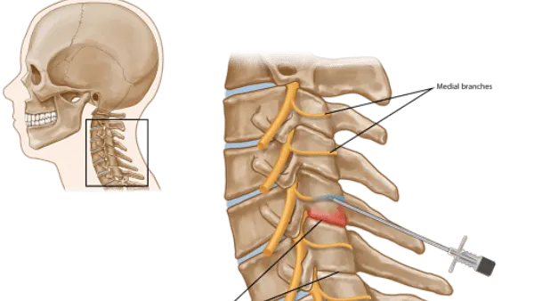 Radiofrequency Ablation