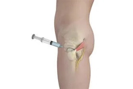 Prolotherapy