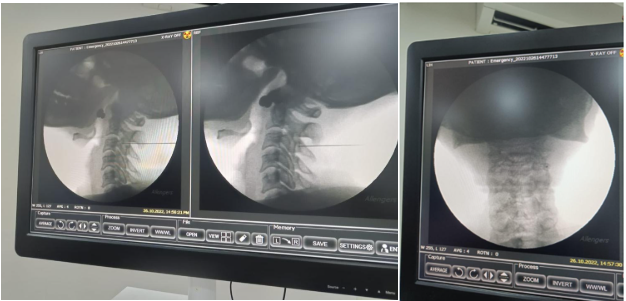Cervical Medial Branch Block