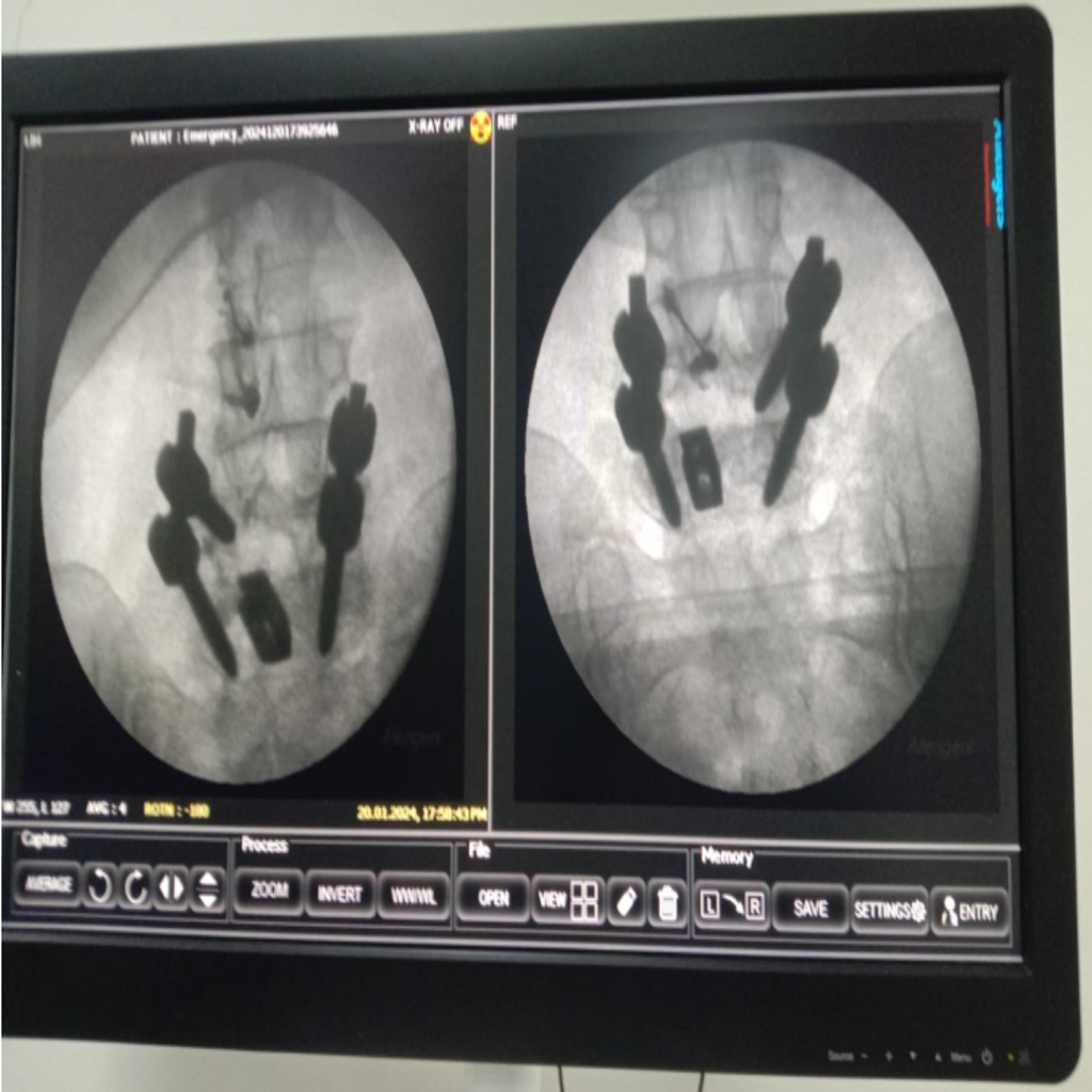 Fluoroscopy guided Intraarticular Facet joint Injection