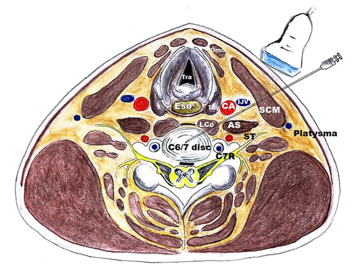 Platelet-Rich Plasma